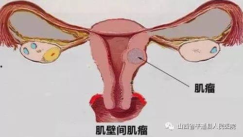 子宫肌瘤吃瓜娄子好吗,子宫肌瘤患者食用瓜娄子的益处与注意事项