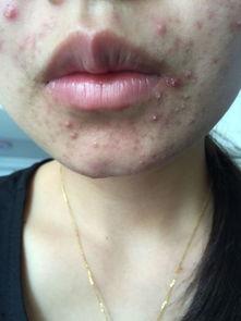 吃瓜容易长痘痘,揭秘吃瓜与痘痘之间的微妙关系